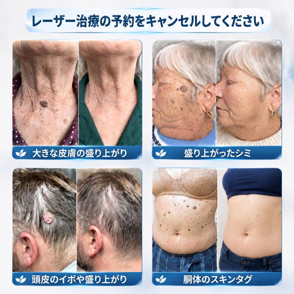 𝐇𝐈𝐒𝐊𝐈𝐍®👩‍⚕️ 7日間 スキンタグ＆スポットイレーサー｜痛み・傷跡を残さず、気になる肌悩みをケアする先進ローラーボールペン