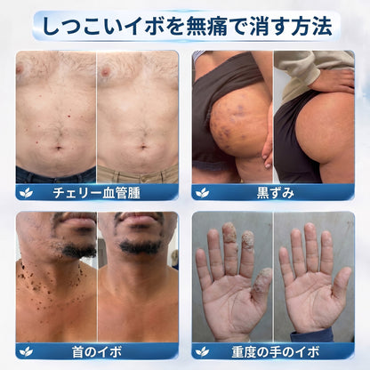 𝐇𝐈𝐒𝐊𝐈𝐍®👩‍⚕️ 7日間 スキンタグ＆スポットイレーサー｜痛み・傷跡を残さず、気になる肌悩みをケアする先進ローラーボールペン