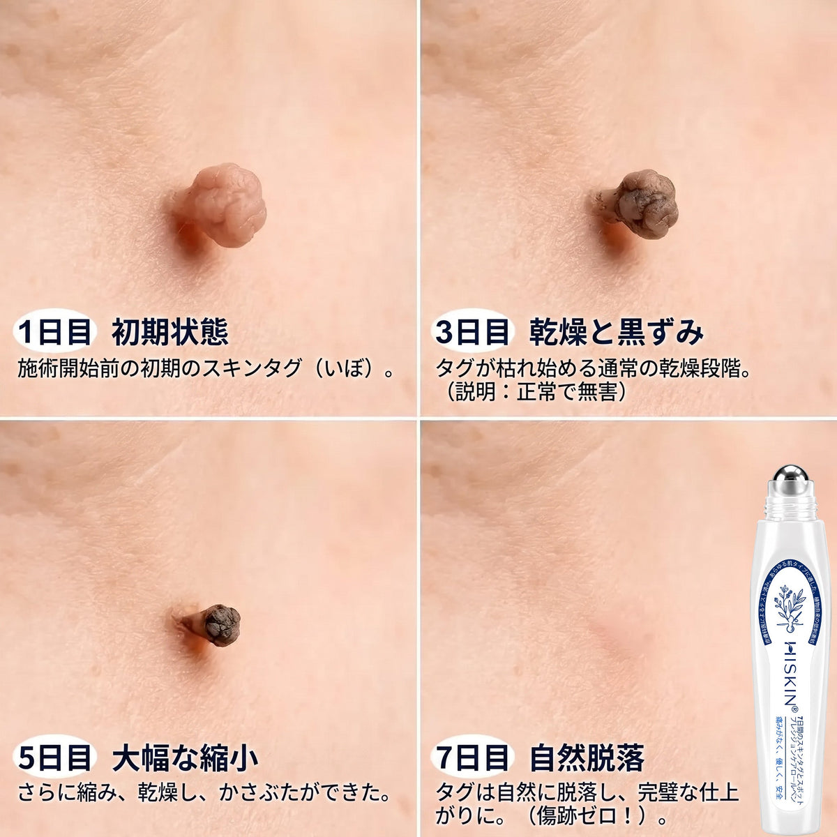 𝐇𝐈𝐒𝐊𝐈𝐍®👩‍⚕️ 7日間 スキンタグ＆スポットイレーサー｜痛み・傷跡を残さず、気になる肌悩みをケアする先進ローラーボールペン